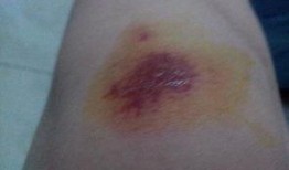 吃瓜伤口流水,揭秘吃瓜伤口流水的惊人真相